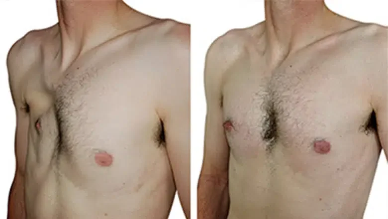 Poland syndrome custom implants male before after