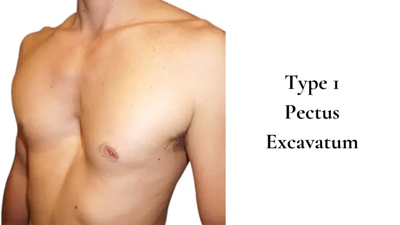 Type 1 Pectus Excavatum