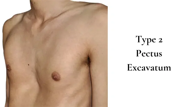 Type 2 Pectus Excavatum