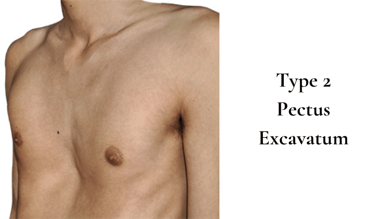 Type 2 Pectus Excavatum