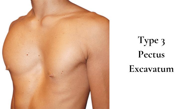 Type 3 Pectus Excavatum