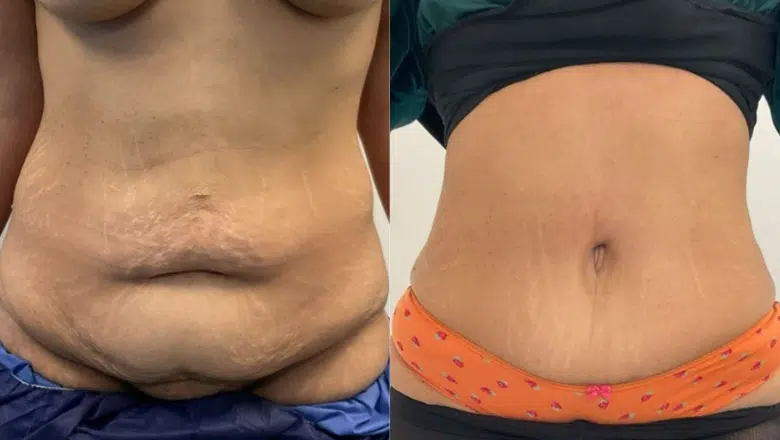 abdominoplasty muscle repair before after