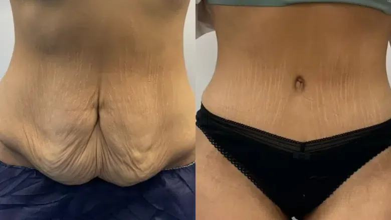 female tummy tuck before after (1)