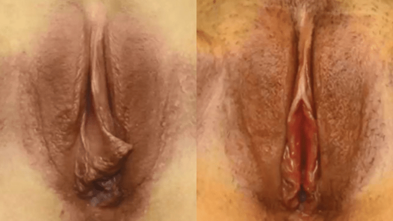 labia minora reduction before after results