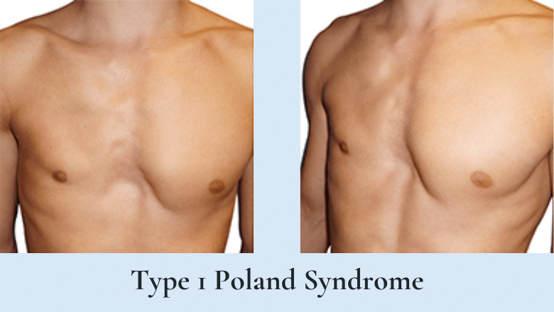 poland syndrome type 1