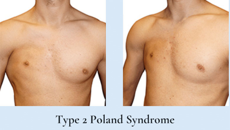 poland syndrome type 2