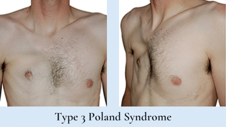 poland syndrome type 3