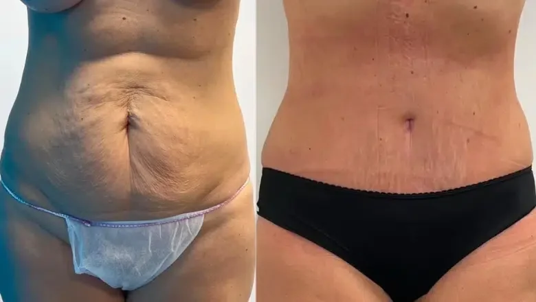 tummy tuck female before after (2)