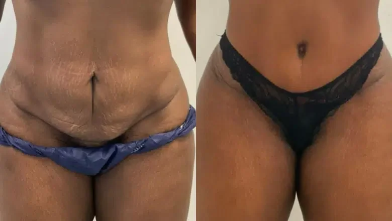 tummy tuck female before after