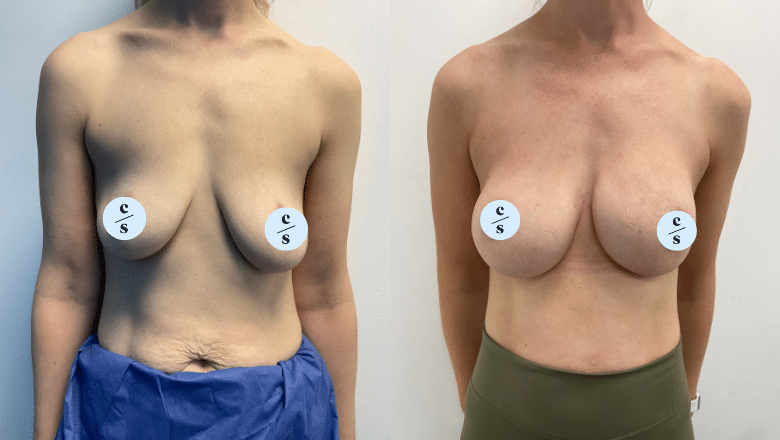 bilateral breast augmentation before after