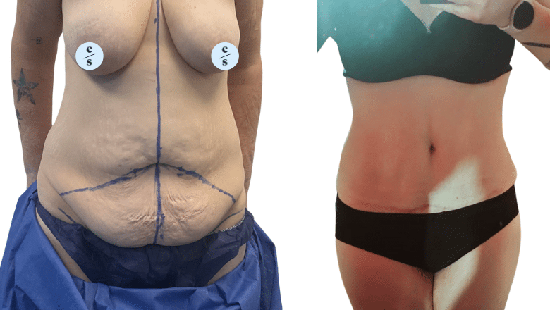 Abdominoplasty UK