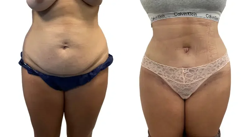 Tummy Tuck Liposuction