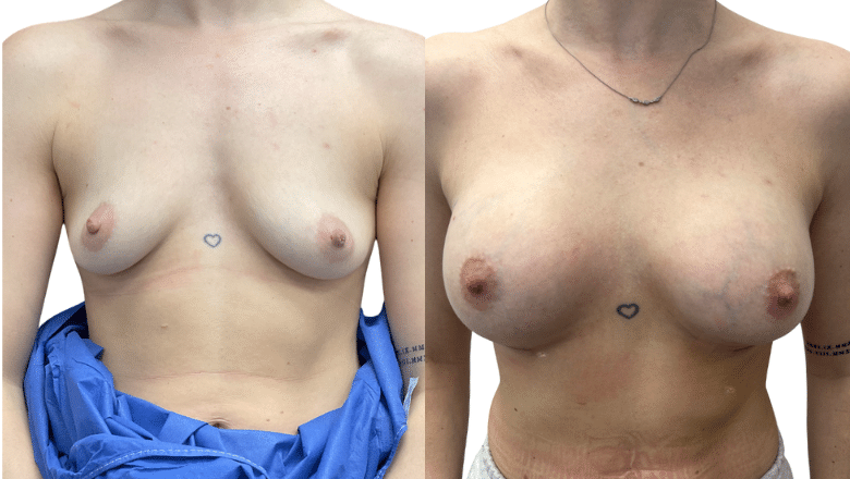 Breast Implant Case