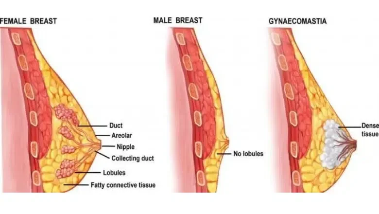 cannabis and gynecomastia