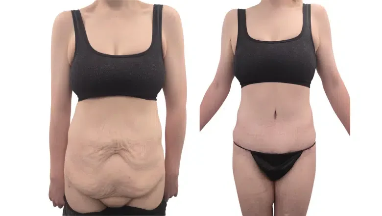 tummy tuck before after results