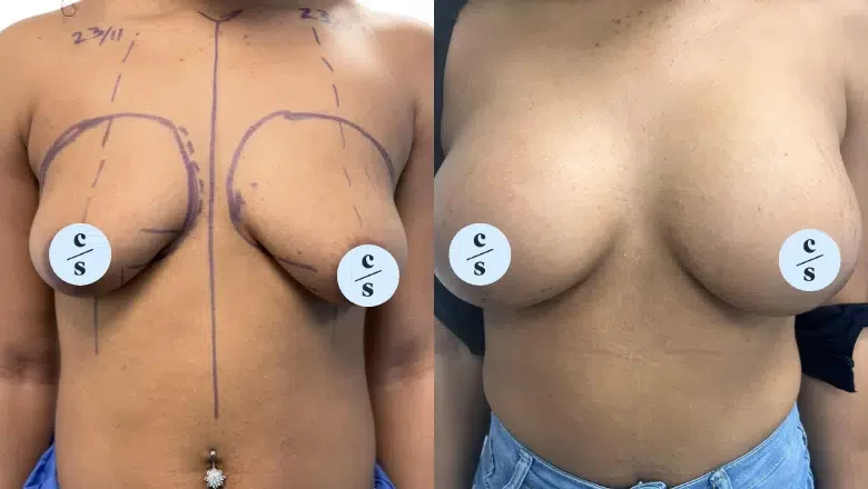 areola reduction and breast lift