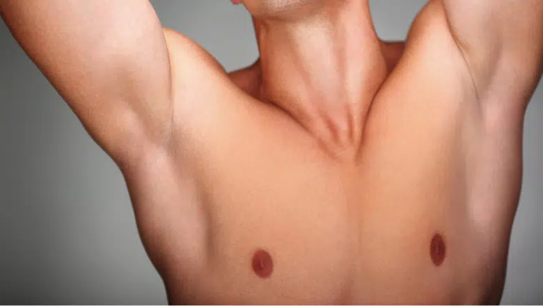 Non-Surgical Treatments for Gynecomastia