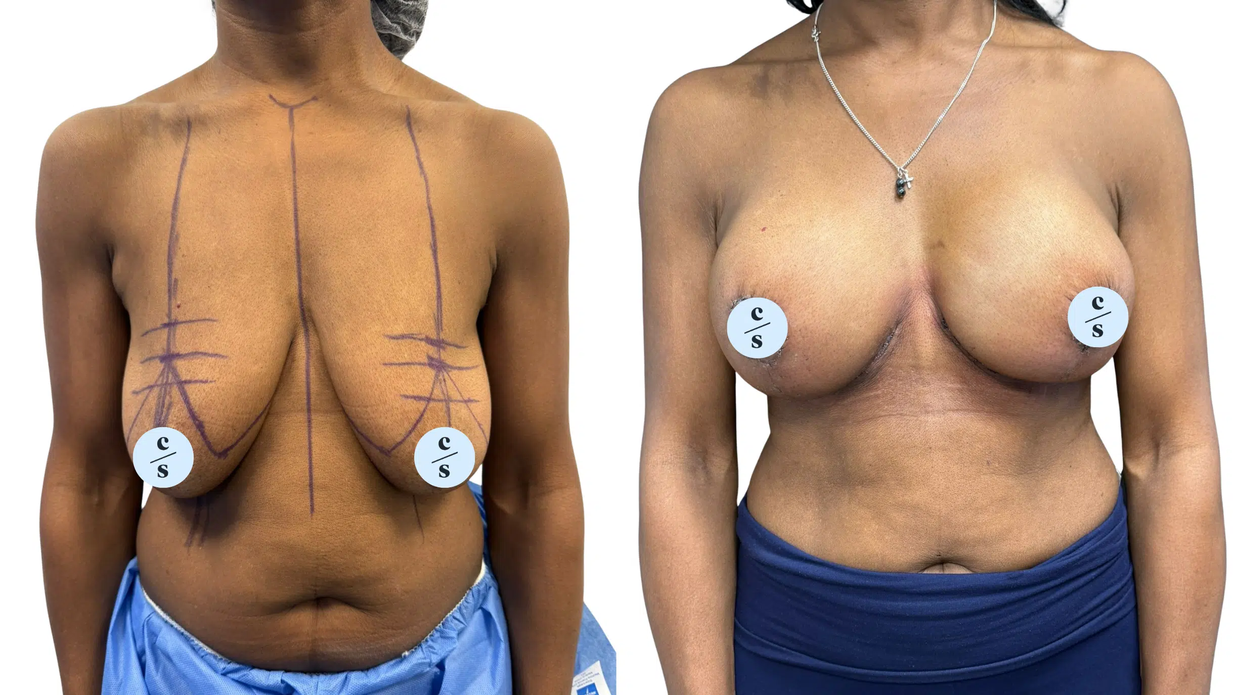 augmentation mastopexy (implant and lift)