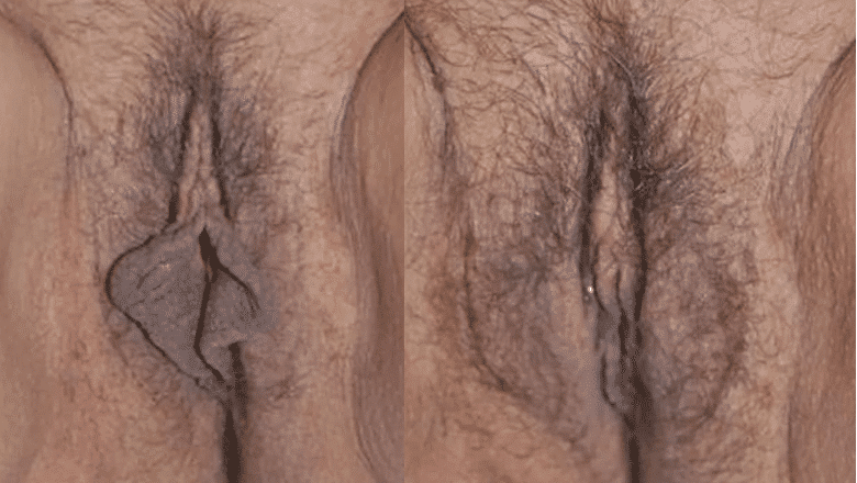 Innie vs Outie Vagina: What Are The Differences? | Centre for Surgery
